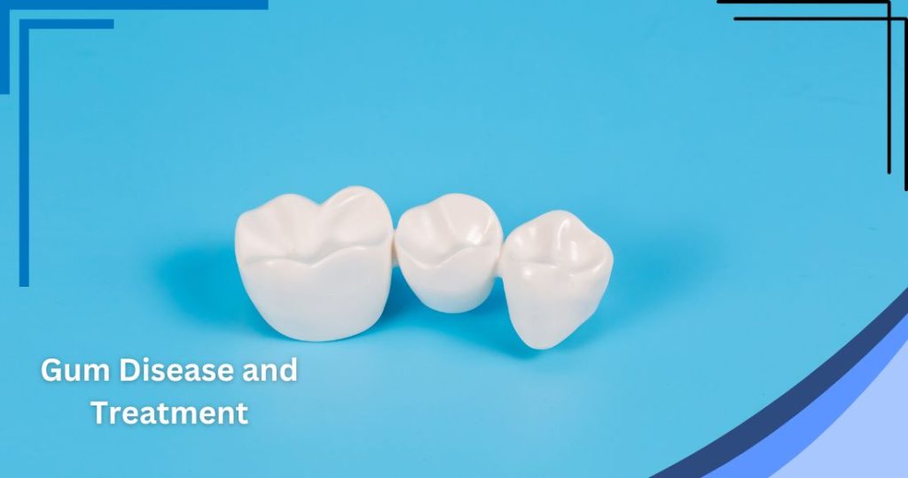 Dental Crown and Bridge Post 7