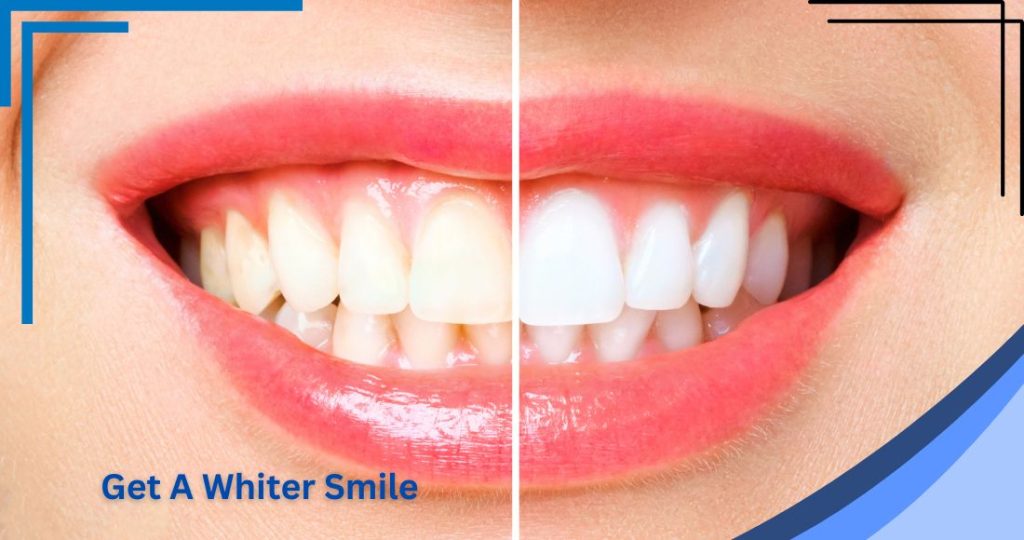 Teeth Whitening - Post 3