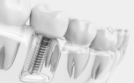 dental implants hamilton new jersey