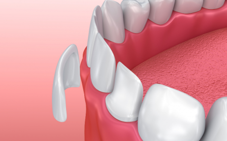 Dental Veneers Hamilton New Jersey